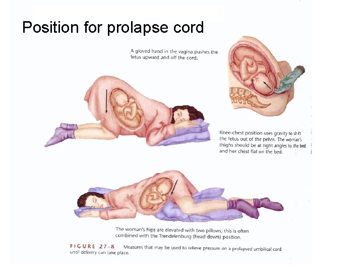 Position for prolapse cord 