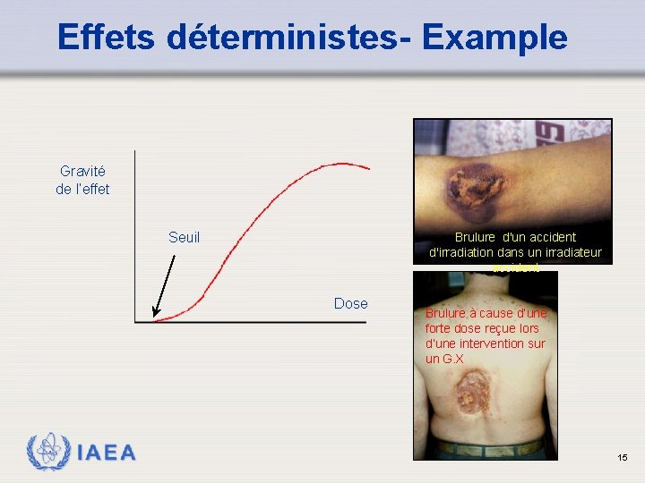 Effets déterministes- Example Gravité de l’effet Seuil Brulure d'un accident d'irradiation dans un irradiateur