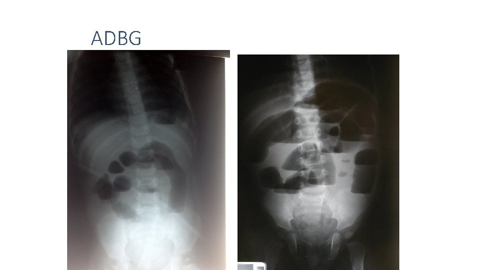 ADBG 