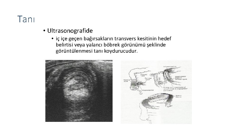 Tanı • Ultrasonografide • iç içe geçen bağırsakların transvers kesitinin hedef belirtisi veya yalancı