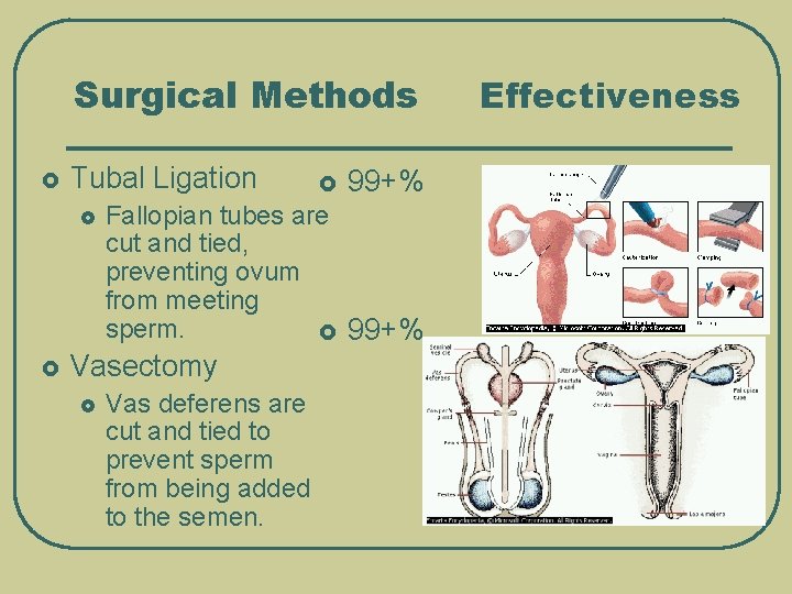 Surgical Methods £ Tubal Ligation £ £ 99+% Fallopian tubes are cut and tied,