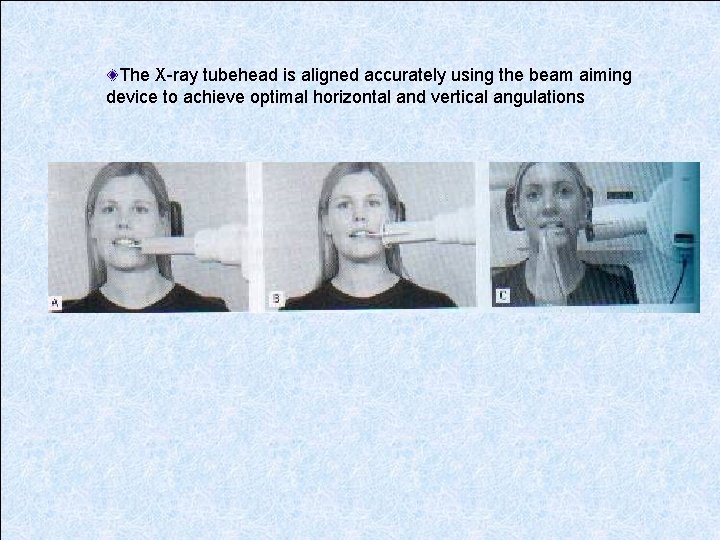 The X-ray tubehead is aligned accurately using the beam aiming device to achieve optimal