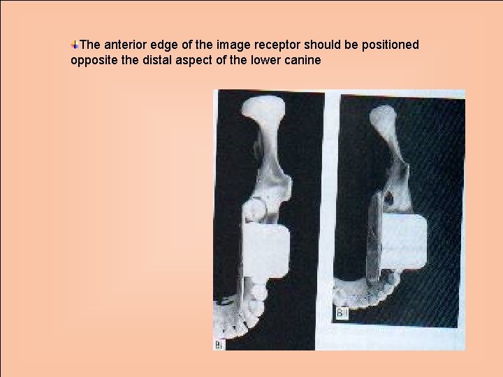The anterior edge of the image receptor should be positioned opposite the distal aspect