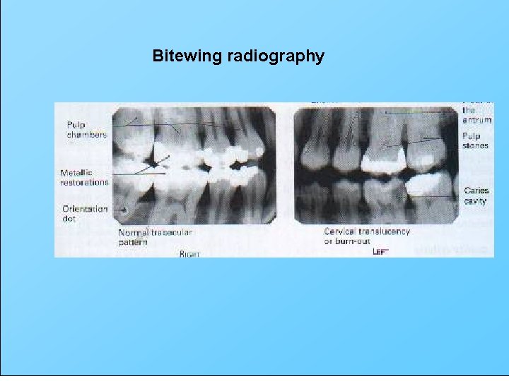 Bitewing radiography 