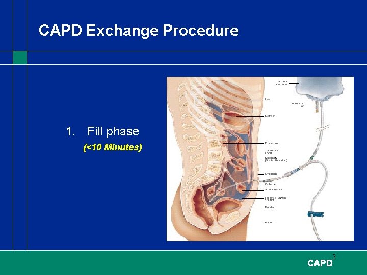 CAPD Exchange Procedure 1. Fill phase (<10 Minutes) 3 CAPD 