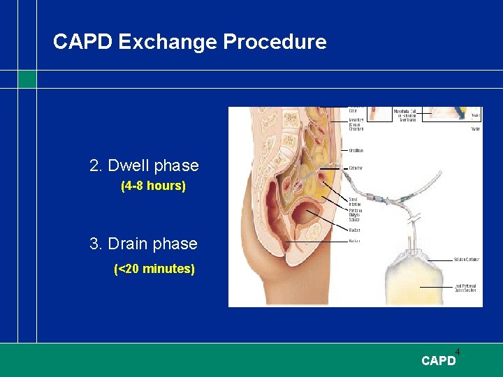 CAPD Exchange Procedure 2. Dwell phase (4 -8 hours) 3. Drain phase (<20 minutes)
