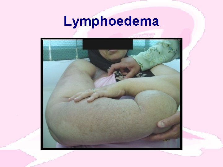 Lymphoedema 