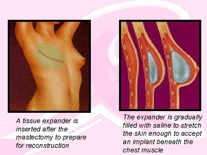 A tissue expander is inserted after the mastectomy to prepare for reconstruction The expander