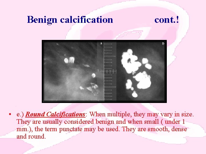 Benign calcification cont. ! • e. ) Round Calcifications: When multiple, they may vary