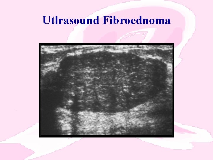 Utlrasound Fibroednoma 