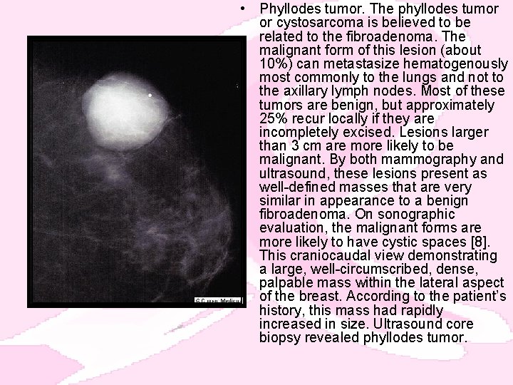  • Phyllodes tumor. The phyllodes tumor or cystosarcoma is believed to be related