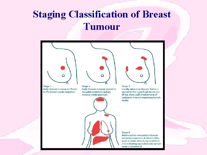 Staging Classification of Breast Tumour 