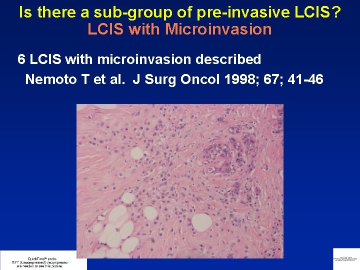 Is there a sub-group of pre-invasive LCIS? LCIS with Microinvasion 6 LCIS with microinvasion