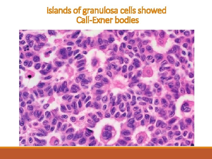 islands of granulosa cells showed Call-Exner bodies 