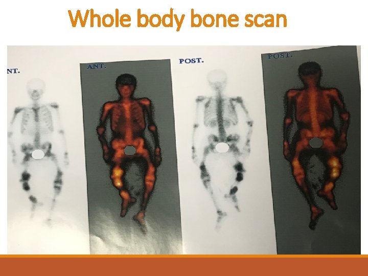 Whole body bone scan 
