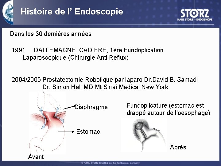 Histoire de l’ Endoscopie Dans les 30 dernières années 1991 DALLEMAGNE, CADIERE, 1ère Fundoplication