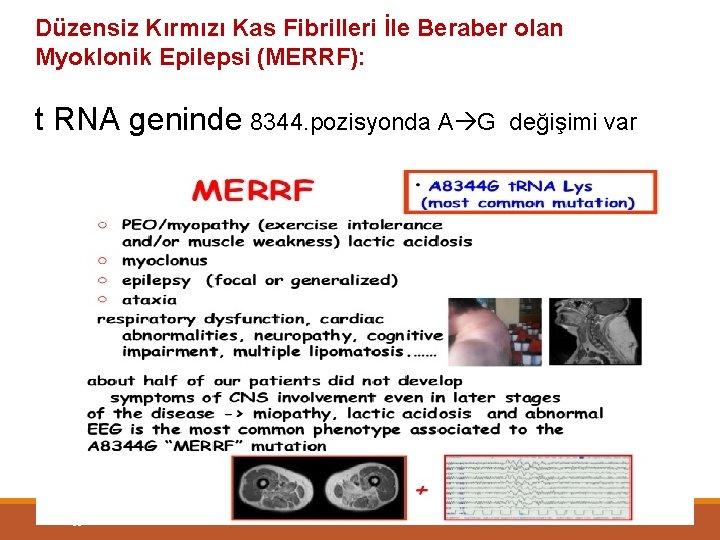 Düzensiz Kırmızı Kas Fibrilleri İle Beraber olan Myoklonik Epilepsi (MERRF): t RNA geninde 8344.
