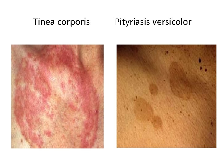 Tinea corporis Pityriasis versicolor Tinea corporis Pityriasis versicolor