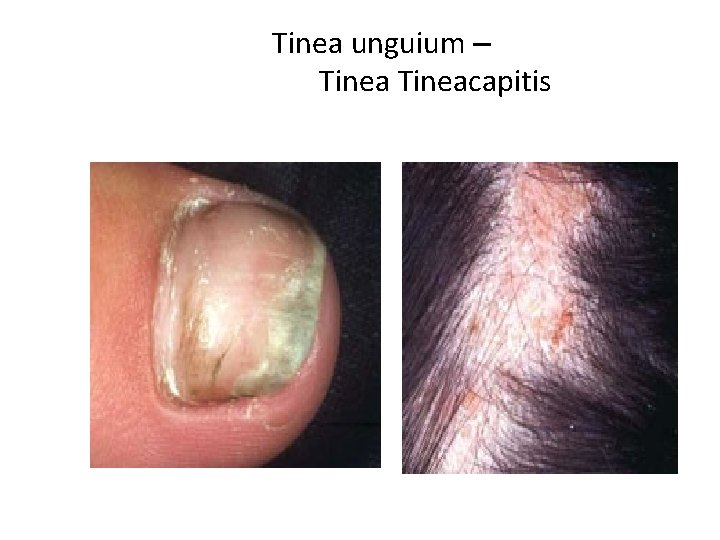 Tinea unguium – Tineacapitis Tinea unguium – Tineacapitis