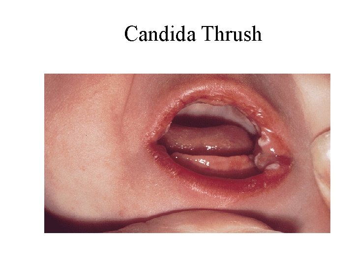Candida Thrush Candida Thrush