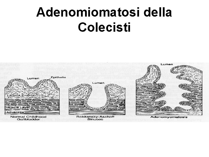 Adenomiomatosi della Colecisti 