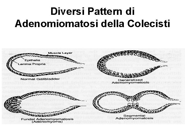 Diversi Pattern di Adenomiomatosi della Colecisti 