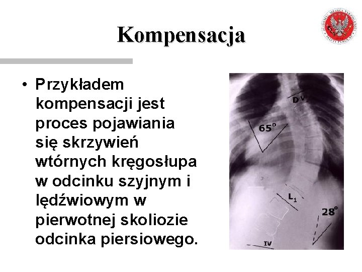 Kompensacja • Przykładem kompensacji jest proces pojawiania się skrzywień wtórnych kręgosłupa w odcinku szyjnym