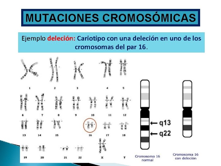 MUTACIONES CROMOSÓMICAS Ejemplo deleción: Cariotipo con una deleción en uno de los cromosomas del