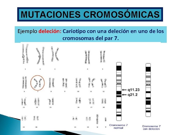 MUTACIONES CROMOSÓMICAS Ejemplo deleción: Cariotipo con una deleción en uno de los cromosomas del