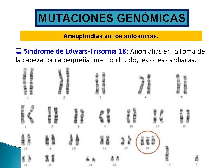 MUTACIONES GENÓMICAS Aneuploidías en los autosomas. q Síndrome de Edwars-Trisomía 18: Anomalías en la