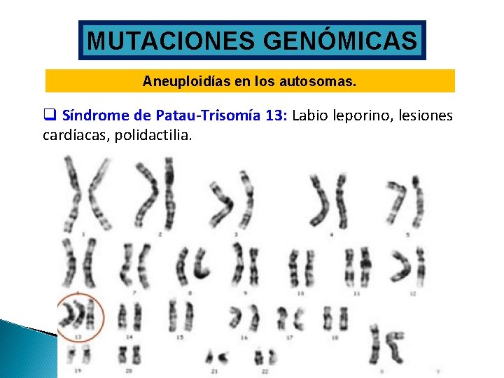 MUTACIONES GENÓMICAS Aneuploidías en los autosomas. q Síndrome de Patau-Trisomía 13: Labio leporino, lesiones