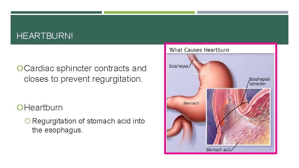 HEARTBURN! Cardiac sphincter contracts and closes to prevent regurgitation. Heartburn Regurgitation of stomach acid