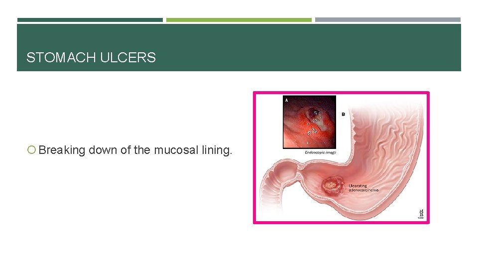 STOMACH ULCERS Breaking down of the mucosal lining. 