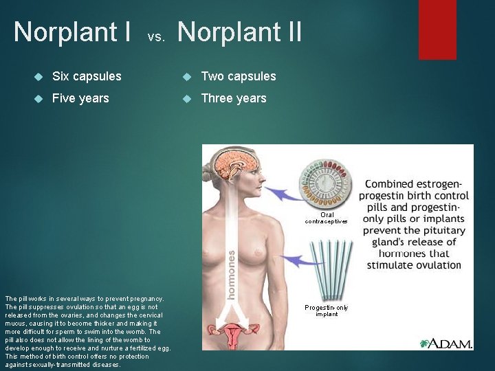 Norplant I vs. Norplant II Six capsules Two capsules Five years Three years The