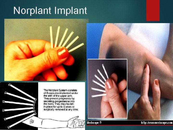 Norplant Implant 