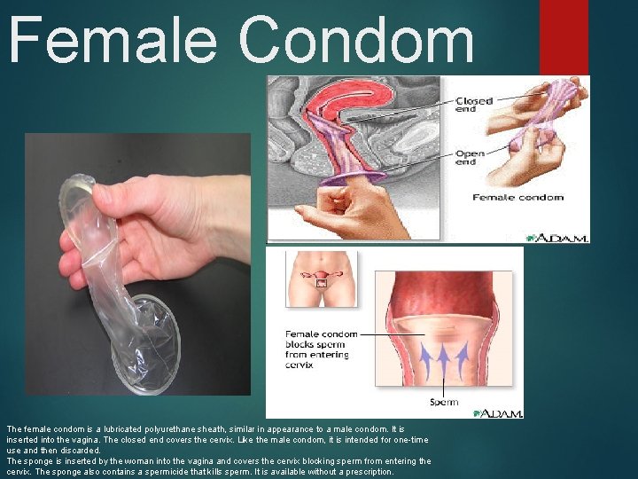 Female Condom The female condom is a lubricated polyurethane sheath, similar in appearance to