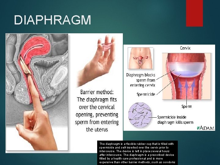 DIAPHRAGM The diaphragm is a flexible rubber cup that is filled with spermicide and