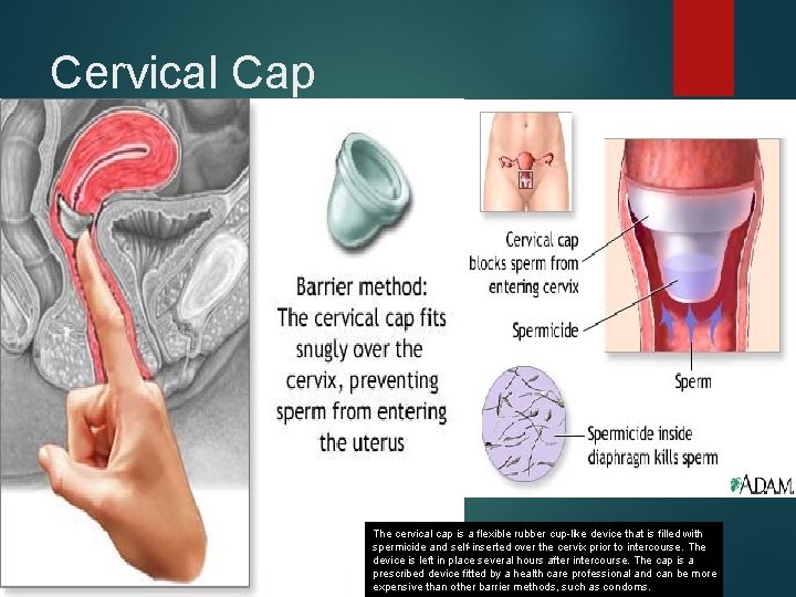 Cervical Cap The cervical cap is a flexible rubber cup-like device that is filled