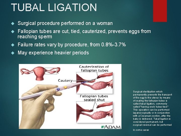 TUBAL LIGATION Surgical procedure performed on a woman Fallopian tubes are cut, tied, cauterized,