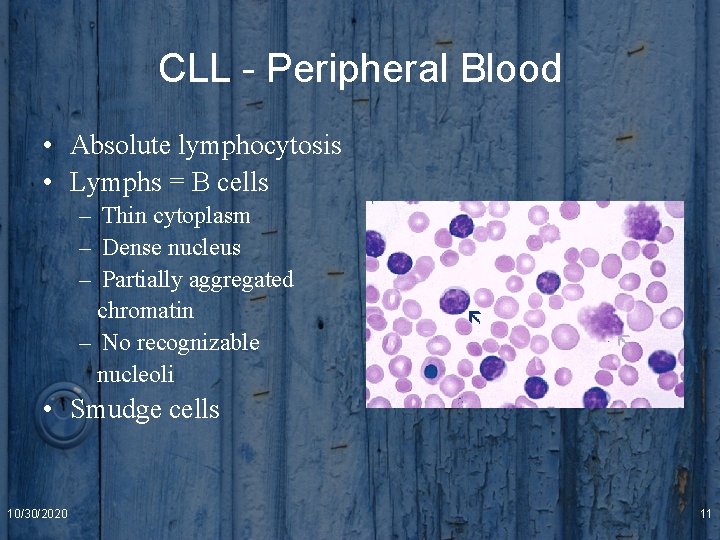 CLL - Peripheral Blood • Absolute lymphocytosis • Lymphs = B cells – Thin