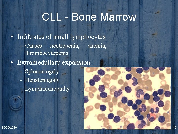 CLL - Bone Marrow • Infiltrates of small lymphocytes – Causes neutropenia, thrombocytopenia anemia,