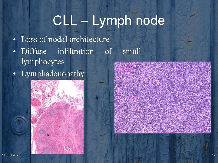 CLL – Lymph node • Loss of nodal architecture • Diffuse infiltration of lymphocytes