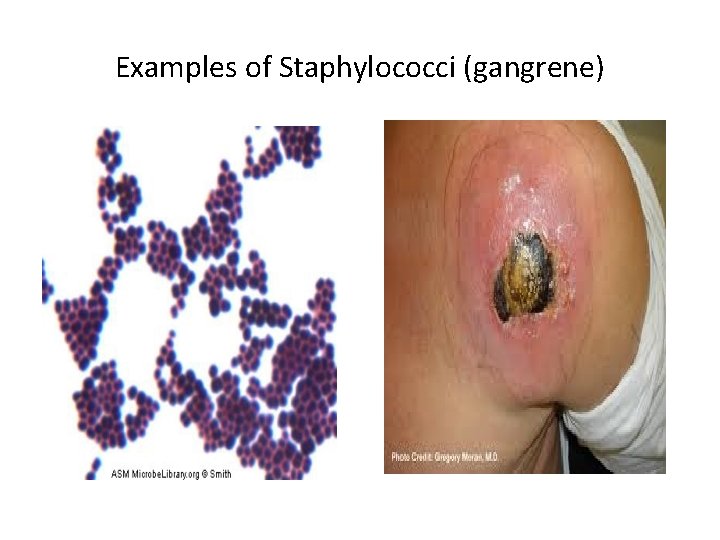 Examples of Staphylococci (gangrene) 