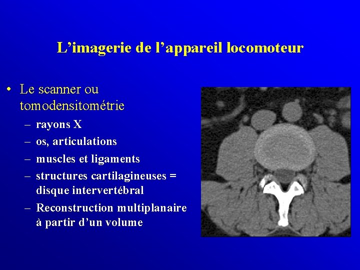 L’imagerie de l’appareil locomoteur • Le scanner ou tomodensitométrie – – rayons X os,