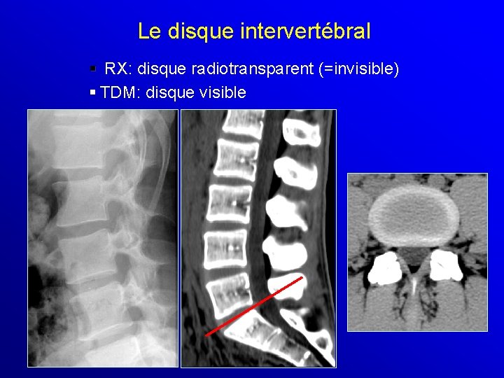 Le disque intervertébral § RX: disque radiotransparent (=invisible) § TDM: disque visible 