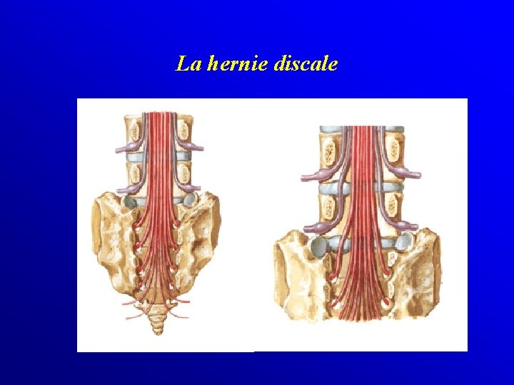 La hernie discale 