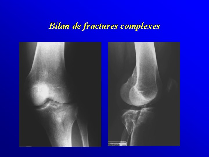 Bilan de fractures complexes 
