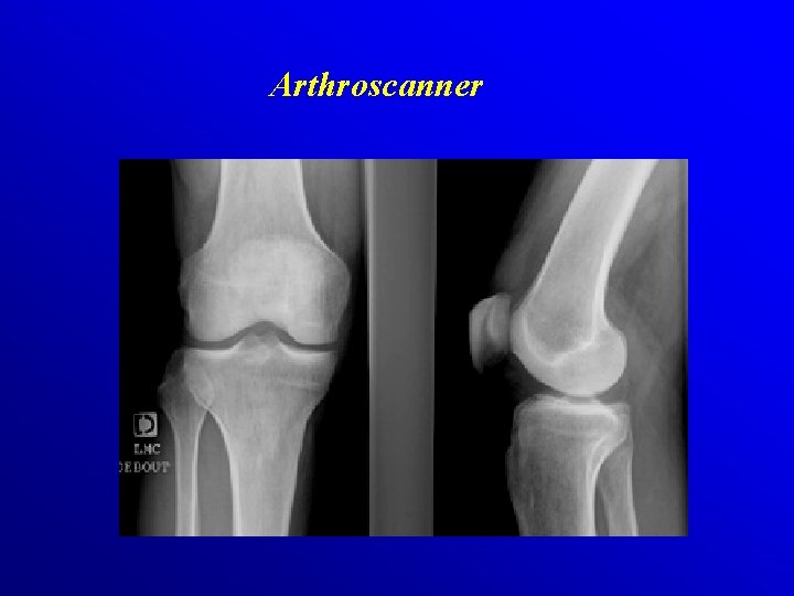 Arthroscanner 