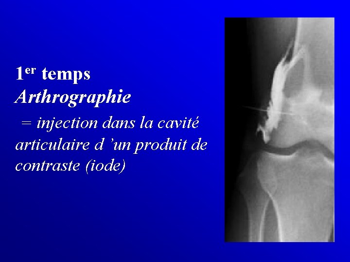 1 er temps Arthrographie = injection dans la cavité articulaire d ’un produit de