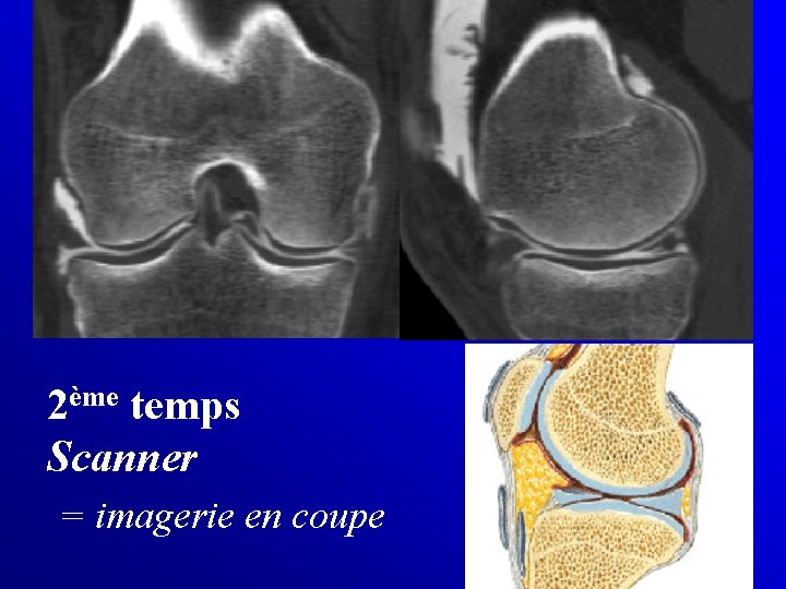 2ème temps Scanner = imagerie en coupe 